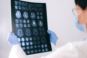 Células de defesa do cérebro podem proteger contra Alzheimer