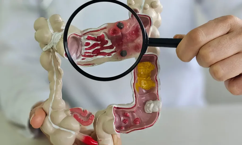 Doenças inflamatórias intestinais aumentam 5x no Brasil