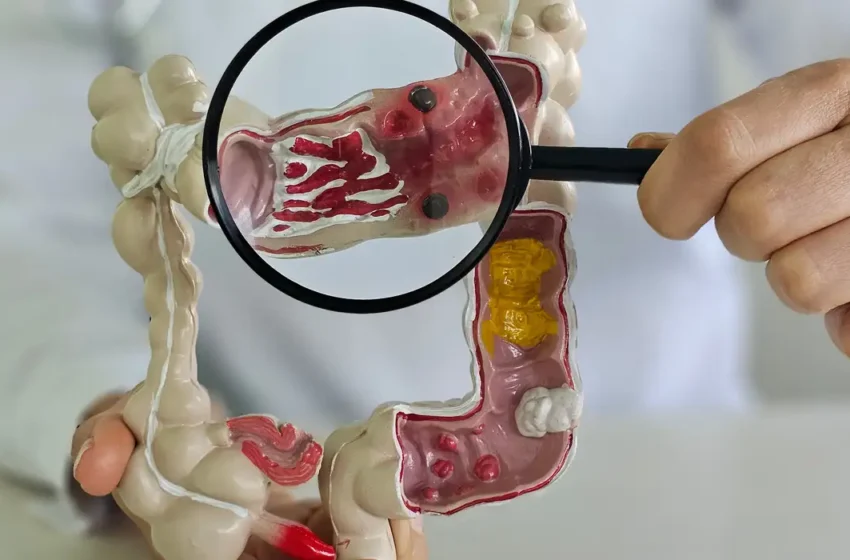  Doenças inflamatórias intestinais aumentam cinco vezes no Brasil em 13 anos